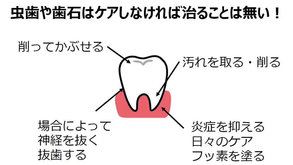 虫歯や歯石のイメージ